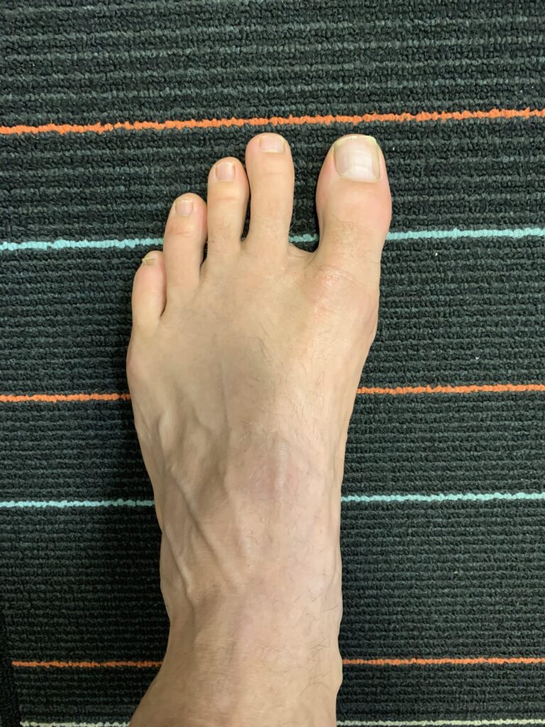 Big toe abduction