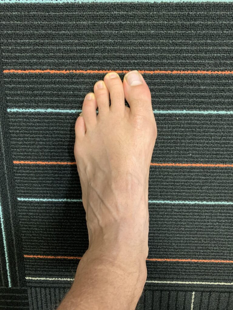 Big toe adduction